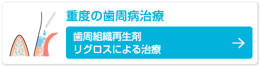 重度の歯周病治療　歯周組織再生剤リグロスによる治療