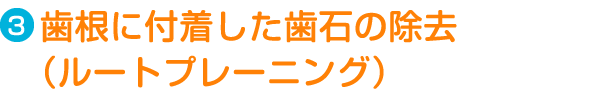 Step3.歯根に付着した歯石の除去（ルートプレーニング）